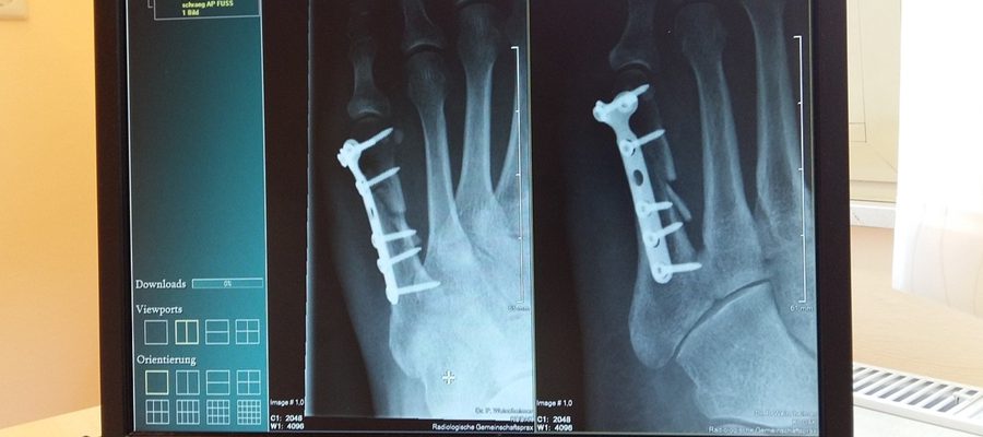 Osteoporoza cichy złodziej kości