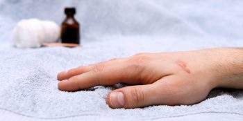 Domowe sposoby na leczenie oparzeń