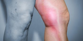 Zakrzepowe zapalenie żył – częsty problem seniorów