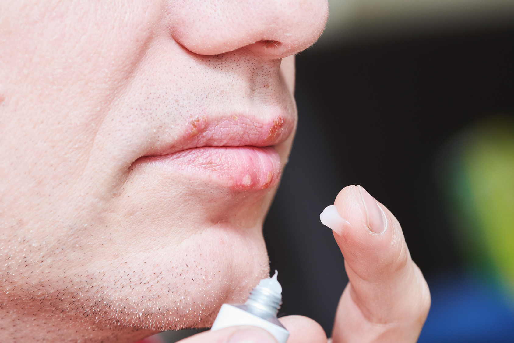 Ziołowa ulga dla ust, czyli bezpieczne leczenie opryszczki wargowej