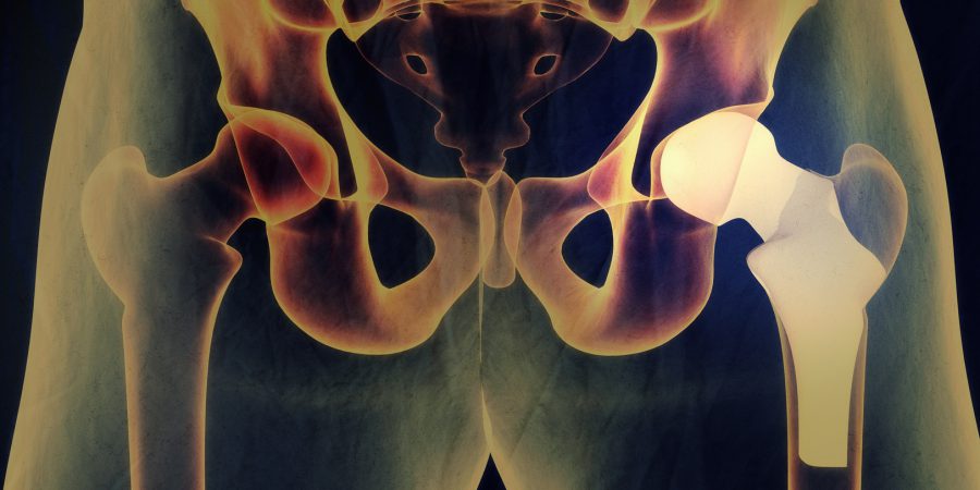 Zwyrodnienie stawów biodrowych – sposób postępowania