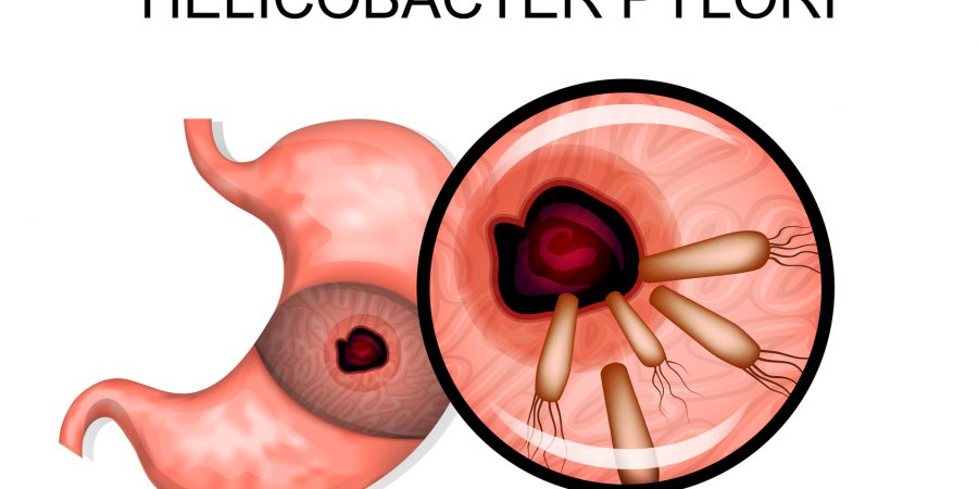 Bakteria Helicobacter pylori a rak żołądka