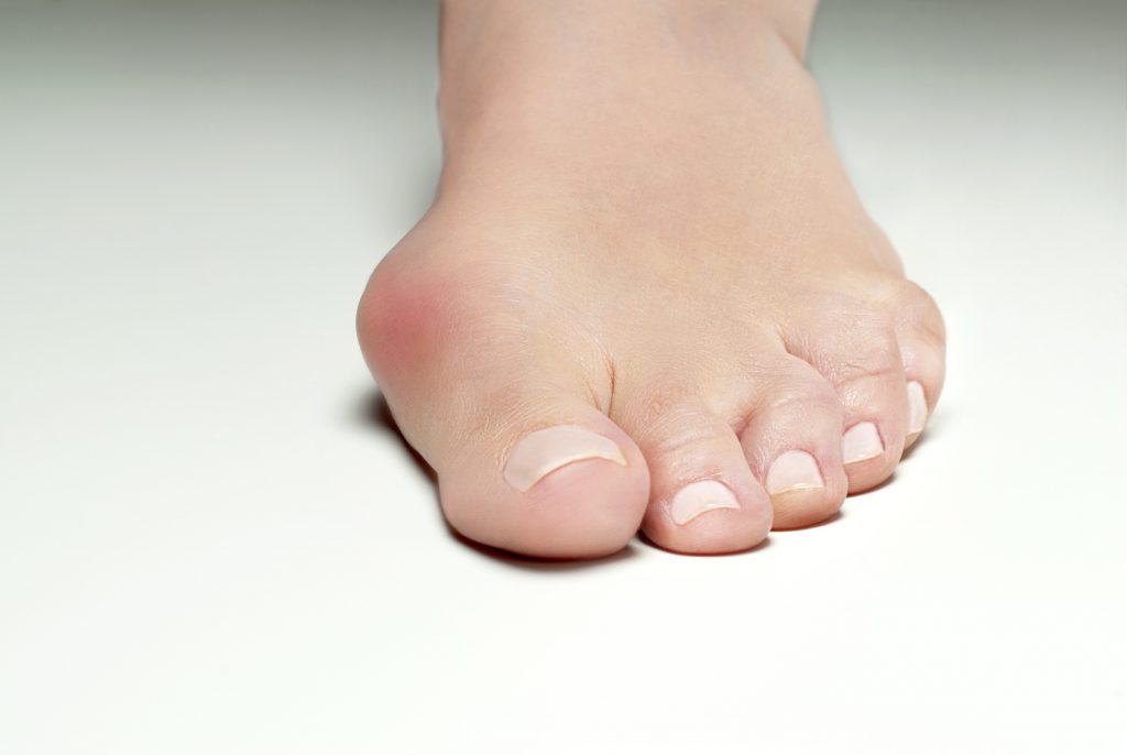 Paluch koślawy - przyczyny oraz leczenie deformacji stopy