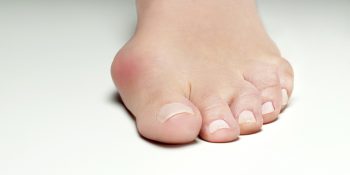 Paluch koślawy - przyczyny oraz leczenie deformacji stopy