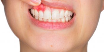 Składniki pożywienia chroniące przez chorobami zębów i dziąseł