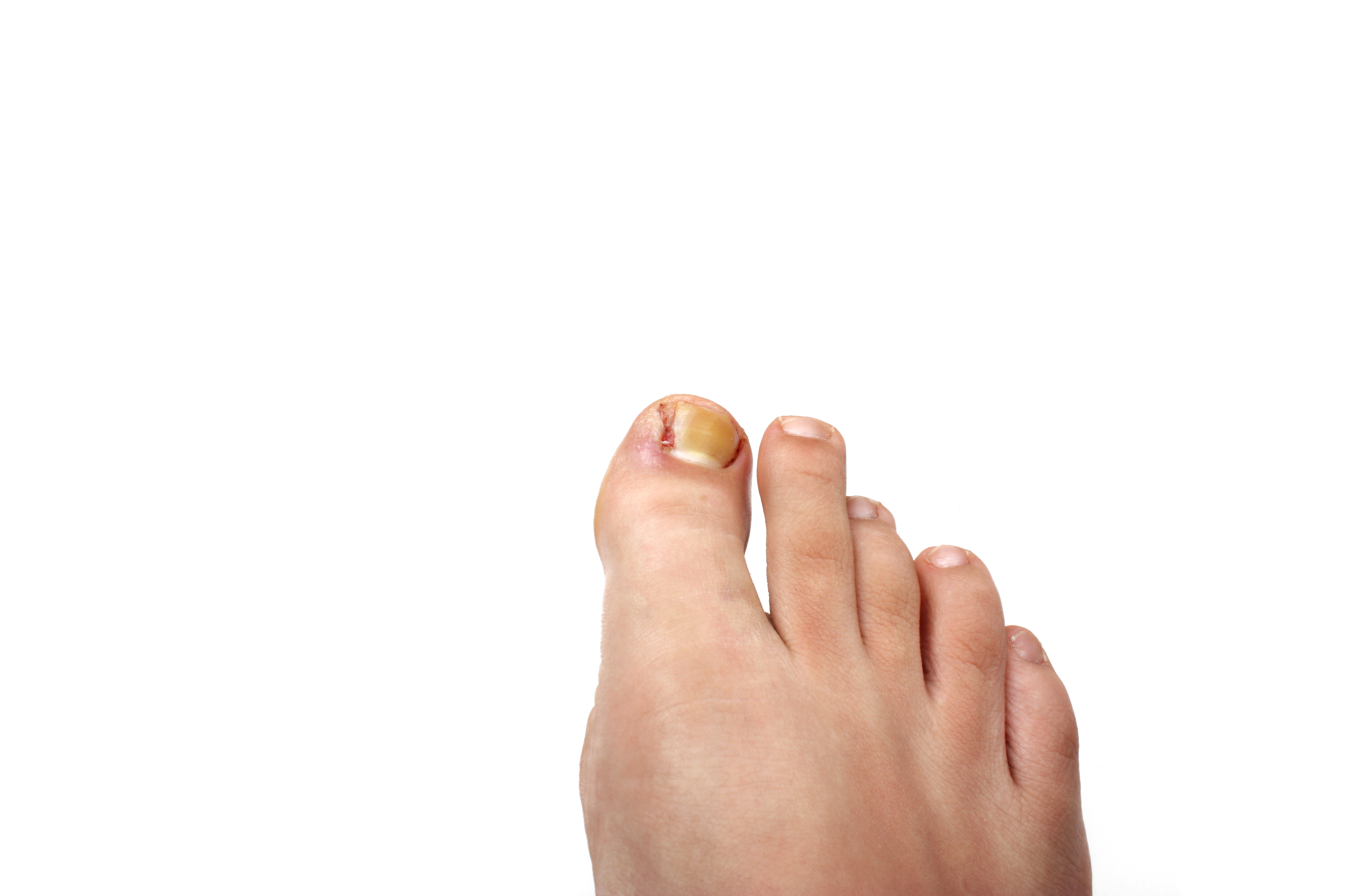 Problem z wrastającymi paznokciami – jakie są przyczyny i jak prawidłowo dbać o paznokcie