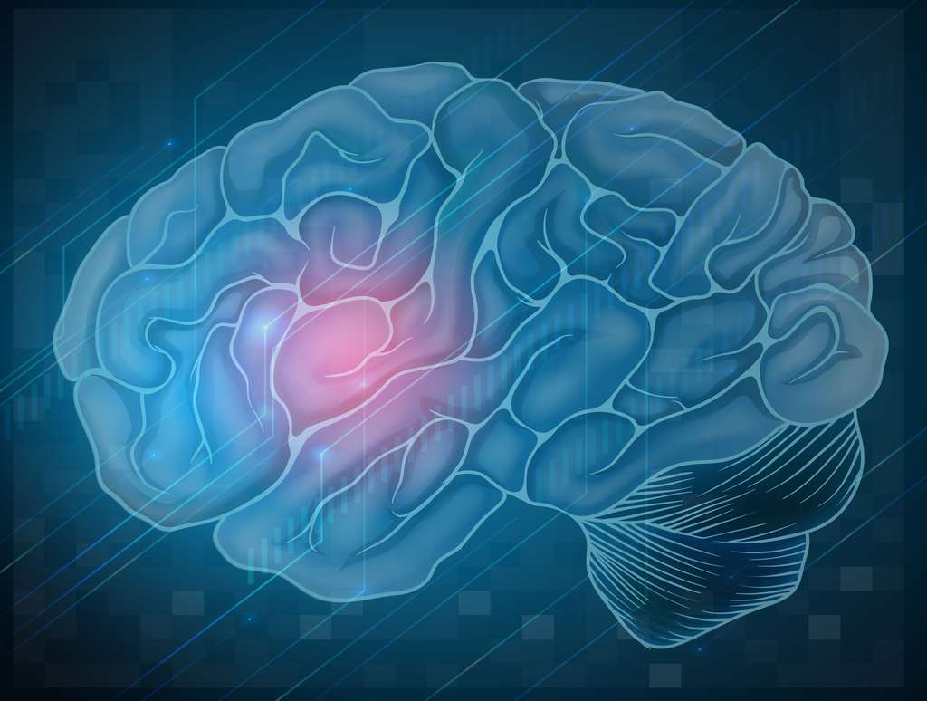Rodzaje udaru mózgu – co dzieje się z mózgiem podczas udaru