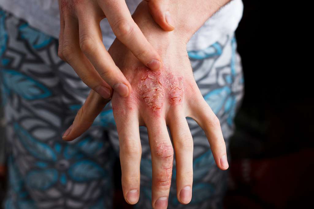 Atopowe zapalenie skóry – przyczyny i objawy