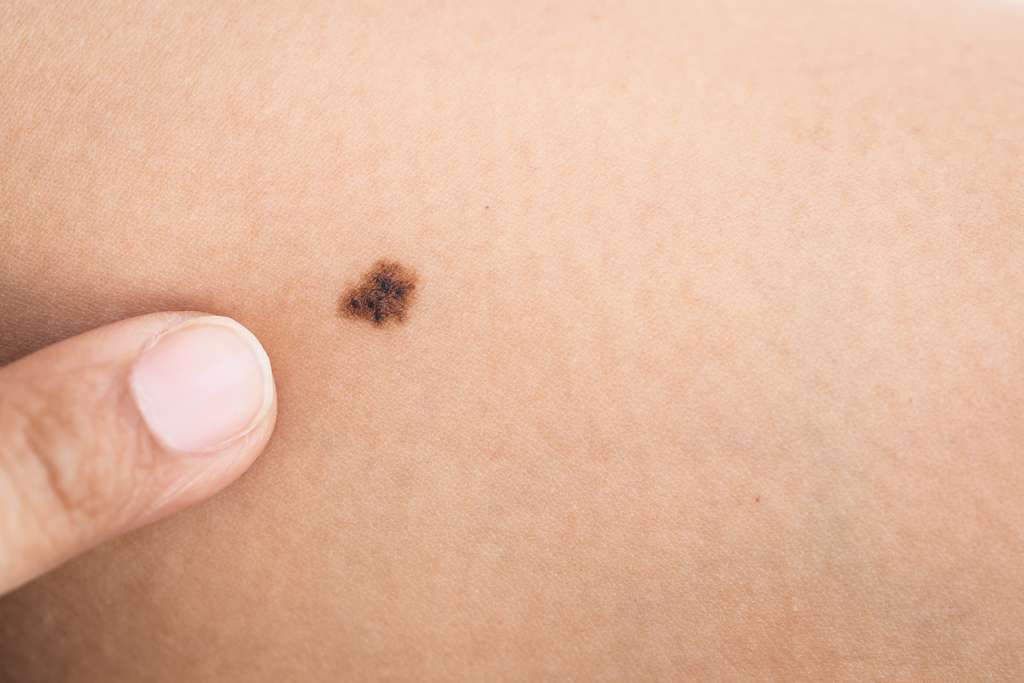 Czerniak skóry – kto jest najbardziej narażony na zachorowanie